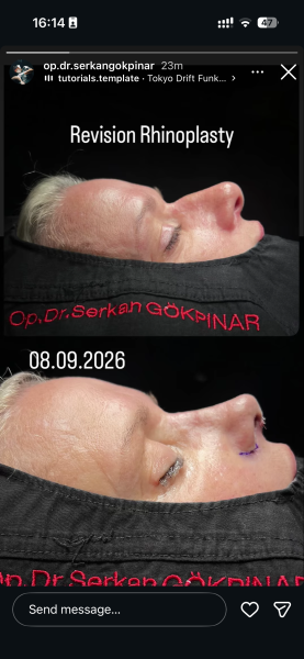 I’ve just had a nose job in Turkey - AMA