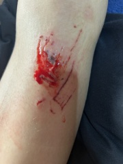 How to heal scrapes and grazes???