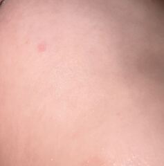 Pox ?