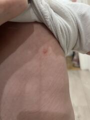 Does this look like Chicken Pox?
