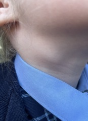 Can anyone else see lymph nodes in their child's neck? (Picture attached)