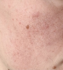 Face redness