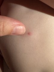 Two year old keeps getting unexplained spots