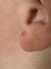 Two year old keeps getting unexplained spots