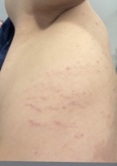 Popped blood vessel or stretch mark