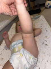 Could this rash be hand, foot and mouth disease?