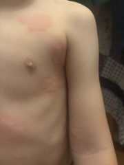 Quickly spreading itchy rash on my three-year-old