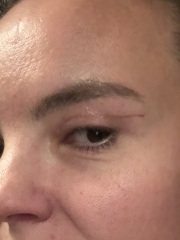 Will a high upper blepharoplasty incision settle and conceal over time?