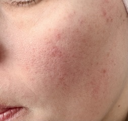 Face redness