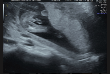 Boy or umbilical cord?