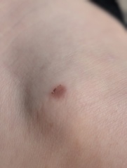 Random bruising again after normal blood tests, should I return to GP?