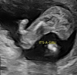 Worried my 16 week private scan may have got sex wrong