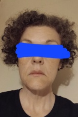 Mini facelift at 47 or are there worthwhile non-surgical alternatives