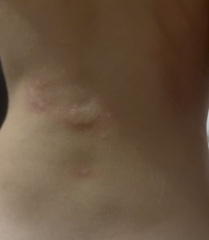 Quickly spreading itchy rash on my three-year-old