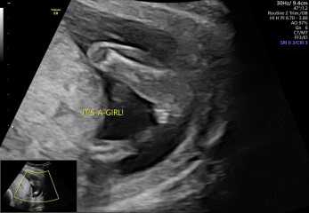 Worried my 16 week private scan may have got sex wrong