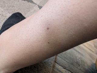 Random bruising again after normal blood tests, should I return to GP?