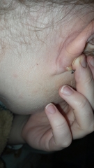 Ear piercing, bump?? Photos attached