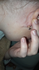 Ear piercing, bump?? Photos attached