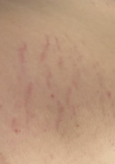 Popped blood vessel or stretch mark