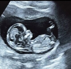 13 weeks pregnant, can anyone guess boy or girl?