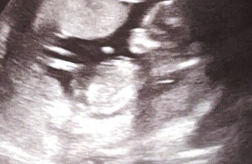 13 weeks pregnant, can anyone guess boy or girl?