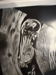 Can anyone guess baby’s sex from my 13 week scan however? Please read my message