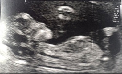 Any gender guesses from these pregnancy scans for our first baby?