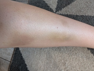 Random bruising again after normal blood tests, should I return to GP?