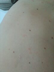 Skin rash