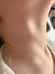 Can anyone else see lymph nodes in their child's neck? (Picture attached)