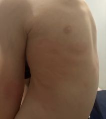 Quickly spreading itchy rash on my three-year-old