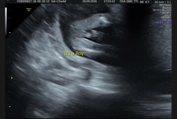 Boy or umbilical cord?