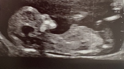 Any gender guesses from these pregnancy scans for our first baby?