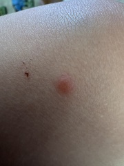 Two year old keeps getting unexplained spots
