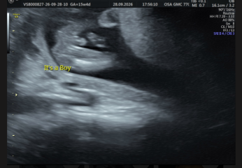 Boy or umbilical cord?