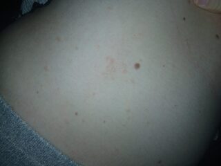 Skin rash