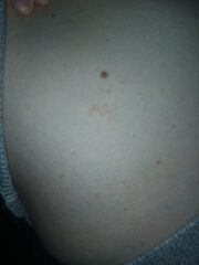Skin rash