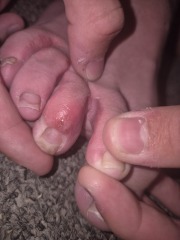 Could this be athlete's foot on my teenage son's foot?