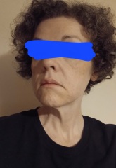 Mini facelift at 47 or are there worthwhile non-surgical alternatives