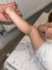 Could this rash be hand, foot and mouth disease?