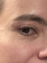 Will a high upper blepharoplasty incision settle and conceal over time?