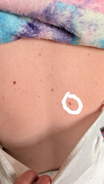 Suspicious mole- 2 week wait