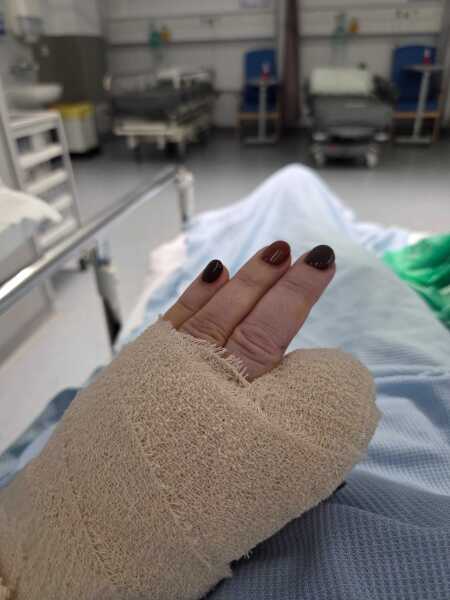 Finger amputation need a hand hold.