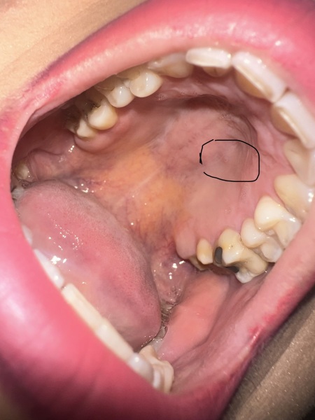Bump roof of mouth