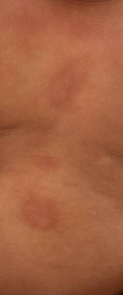 Baby’s dry skin patches – eczema or cow’s milk allergy?