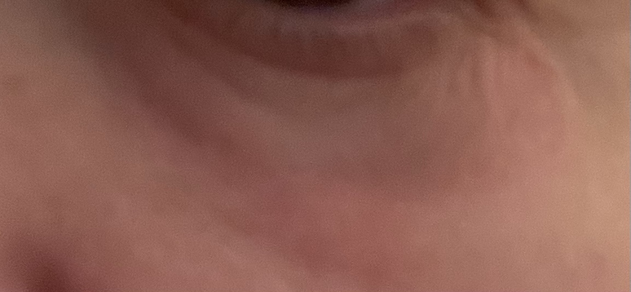 Totally fed up with this skin issue under eyes now, awaiting telepathway dermatology review pics attached