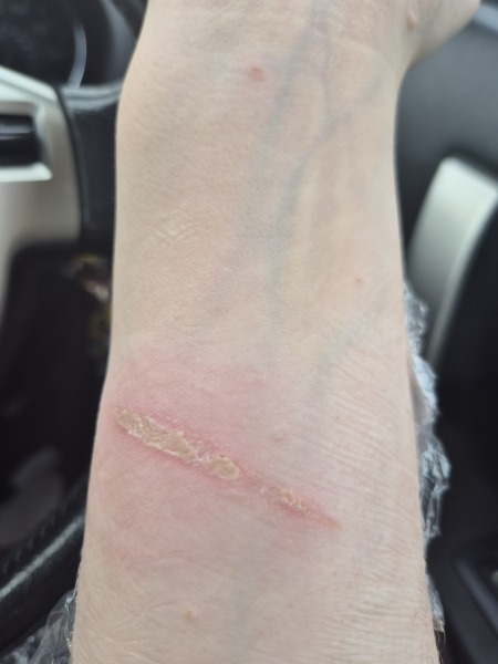 Is this burn infected?