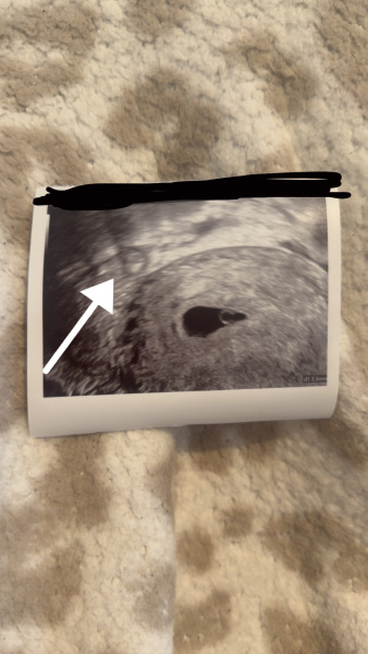5 weeks scan…. What is this circle ??