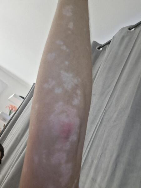 Skin condition taking over my life