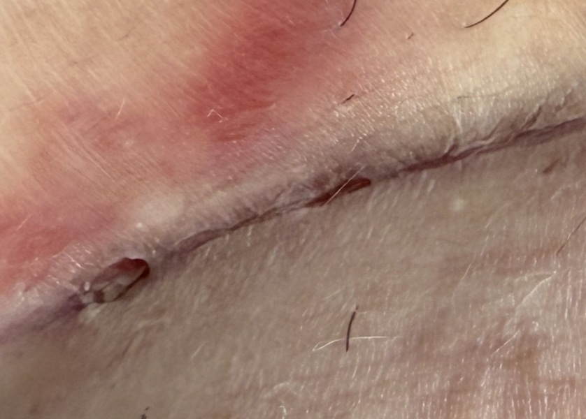 C section incision?